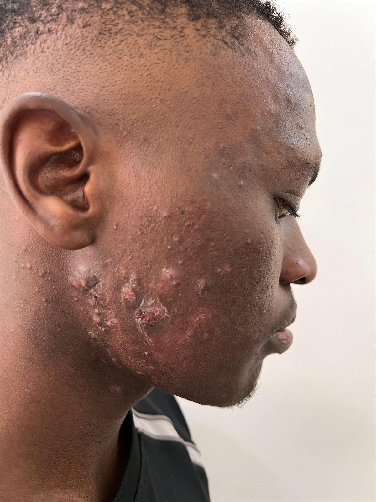 Acne and acne scarring on the cheek and jaw